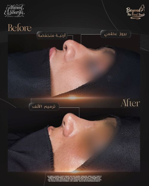 عملية ترميم الأنف